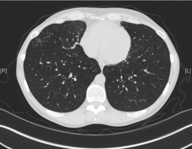 ct-lung-scan